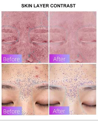 kupować Blue Light Acne Treatment Mask with Intelligent Timer – Manufacturer Direct Supply, Appearance Patent Included produkcja internetowa